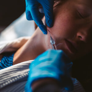 Enzima (Intradermoterapia) - Manchas