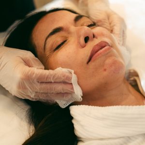 Peeling Quimico